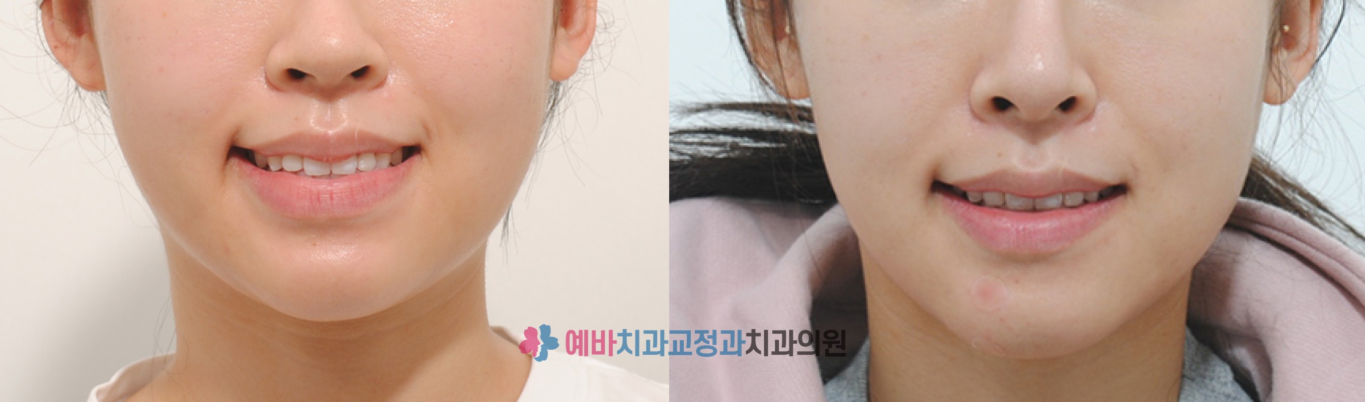 돌출입 교정 전/후  전후사진