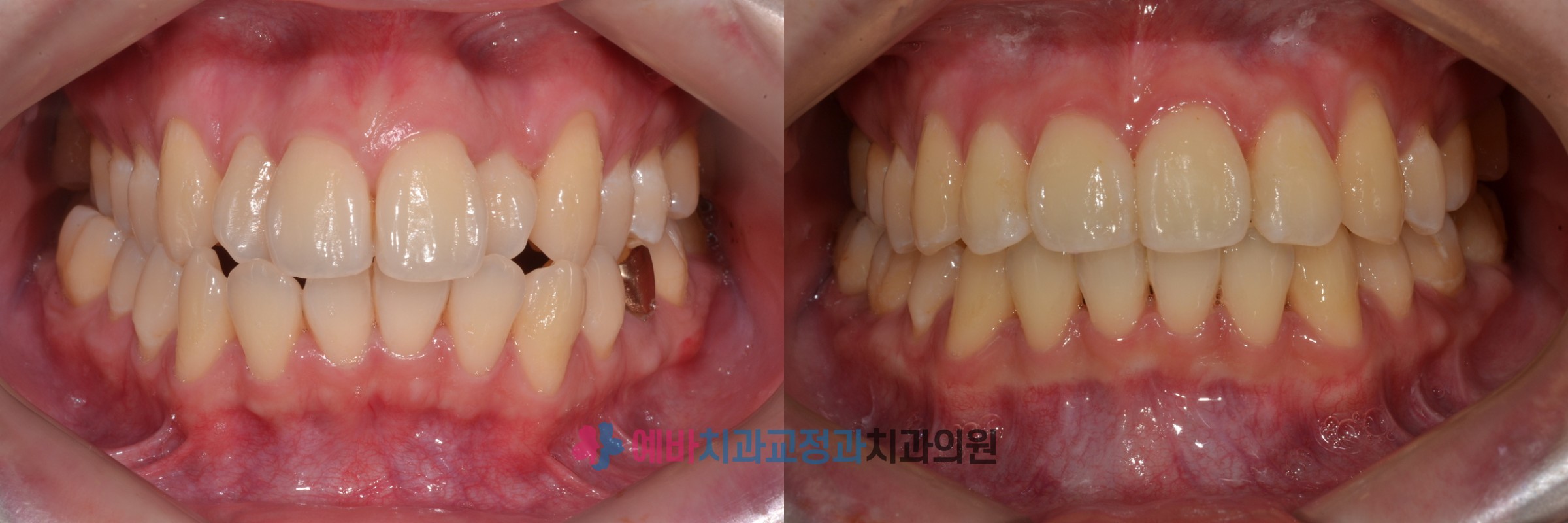 덧니 교정 전/후 전후사진