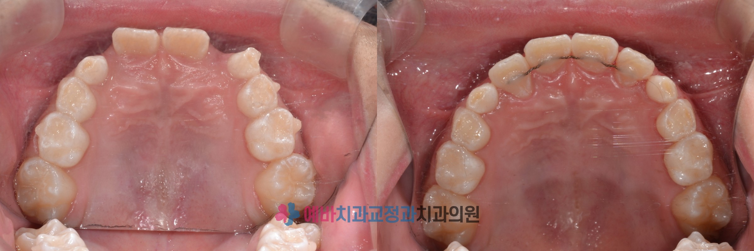 성장교정 전/후 전후사진