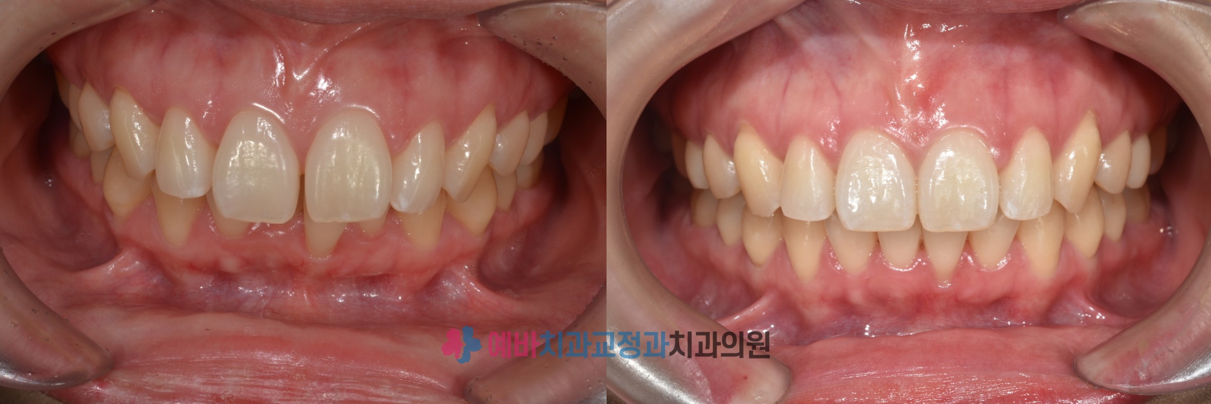 돌출입 교정 전/후