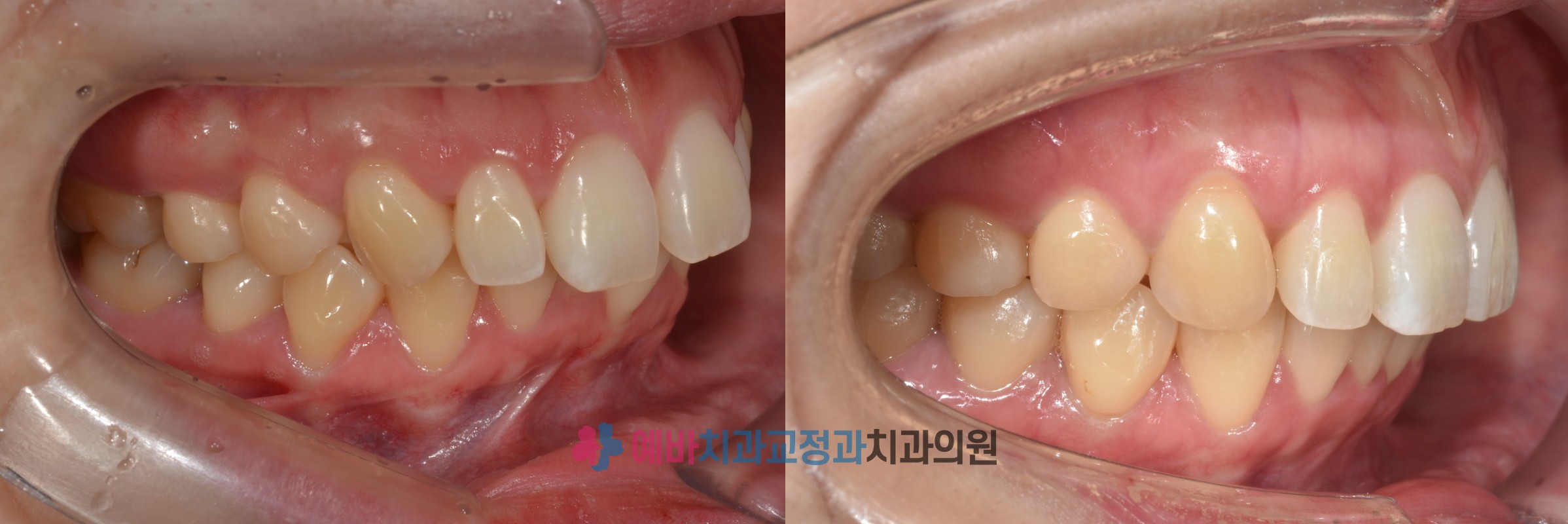 돌출입 교정 전/후  전후사진