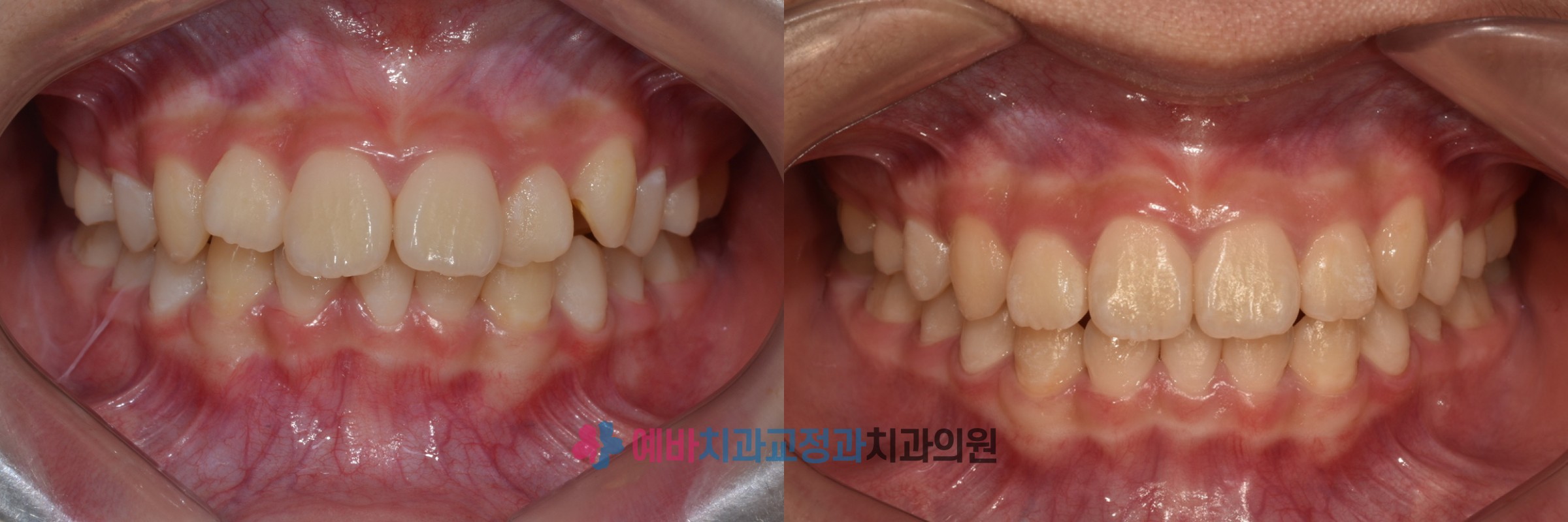 앞니 영구치 결손 성장교정 전/후 전후사진