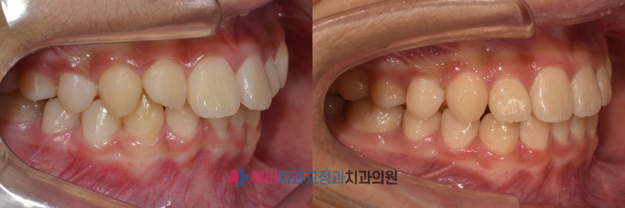 앞니 영구치 결손 성장교정 전/후 전후사진