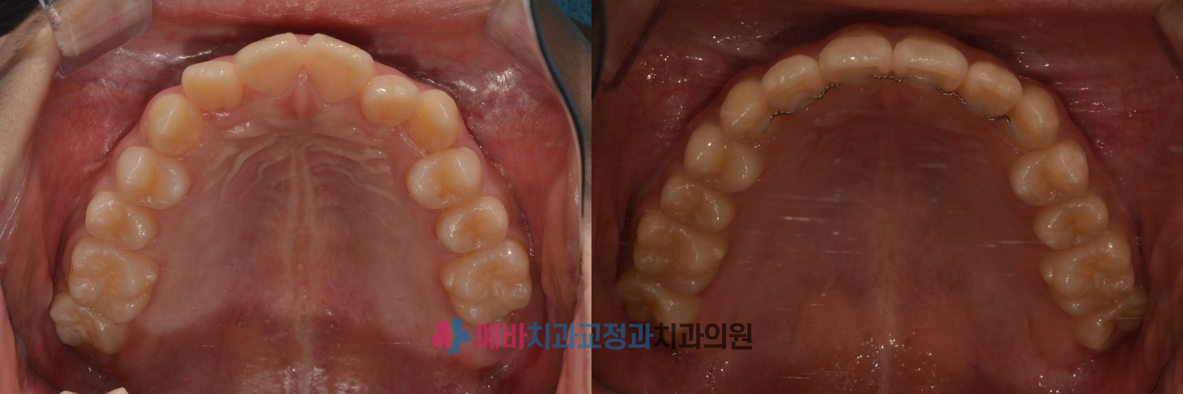 앞니 영구치 결손 성장교정 전/후 전후사진