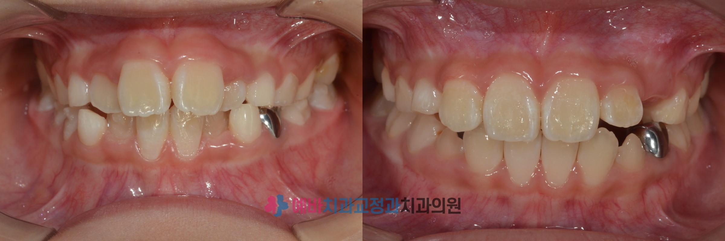 영구치 맹출 자리확보 성장교정 전/후 전후사진