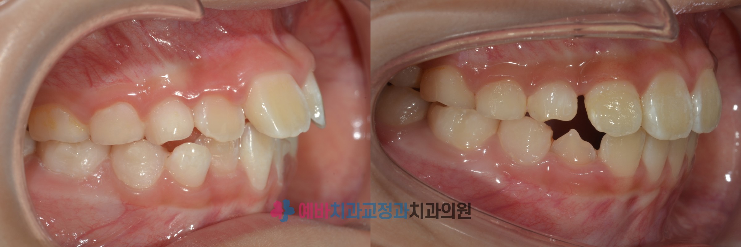 영구치 맹출 자리확보 성장교정 전/후 전후사진