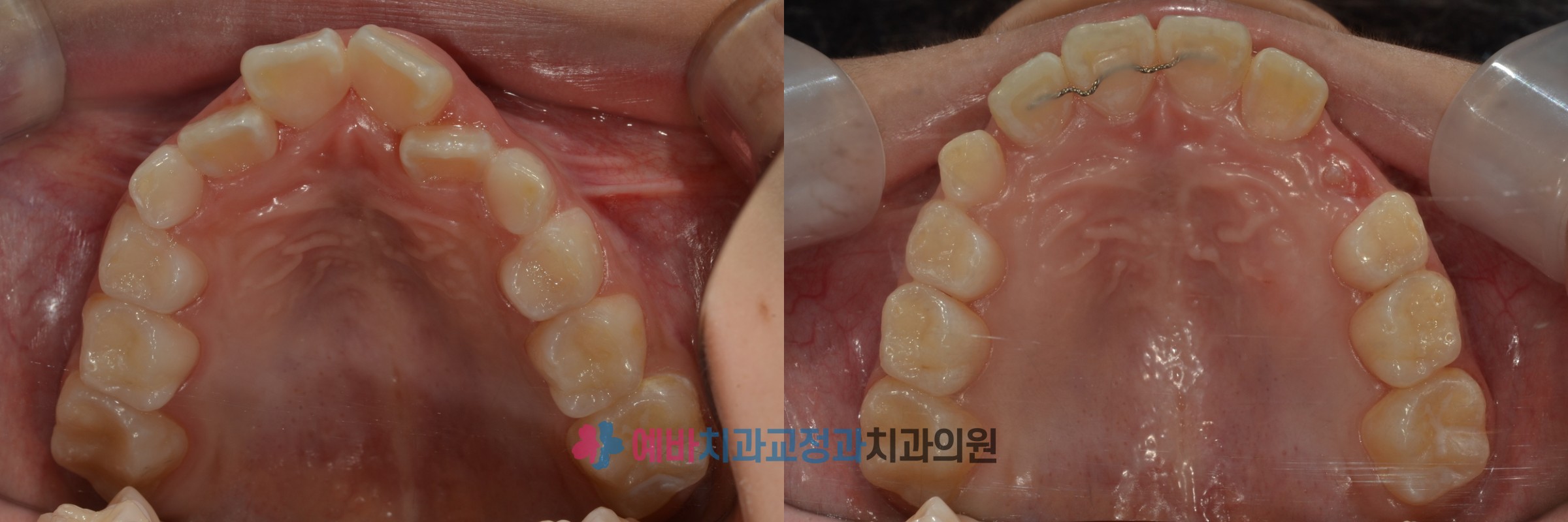 영구치 맹출 자리확보 성장교정 전/후 전후사진