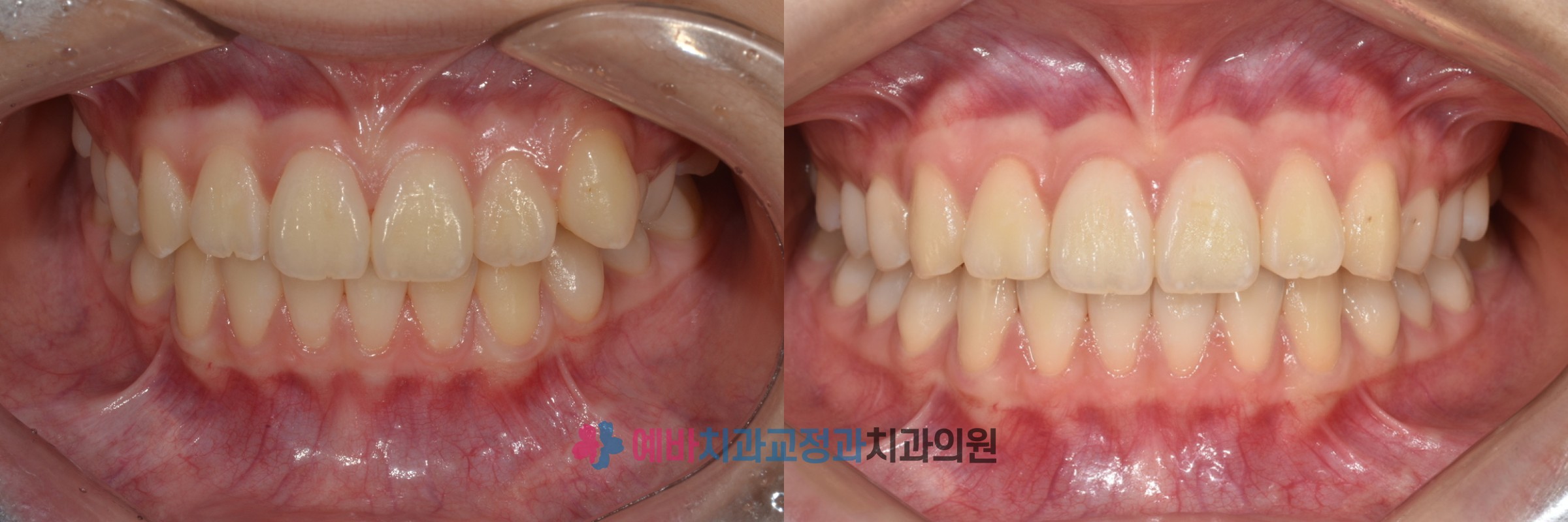 돌출입·덧니, 발치 없이 교정 전/후 전후사진