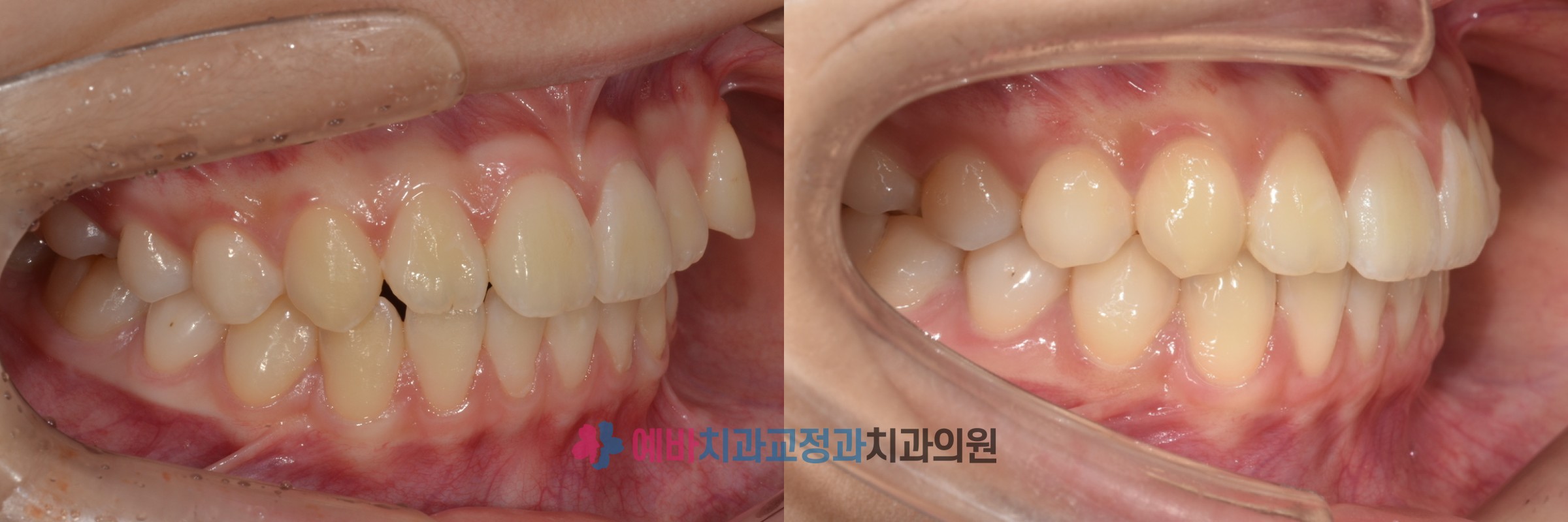 돌출입·덧니, 발치 없이 교정 전/후 전후사진