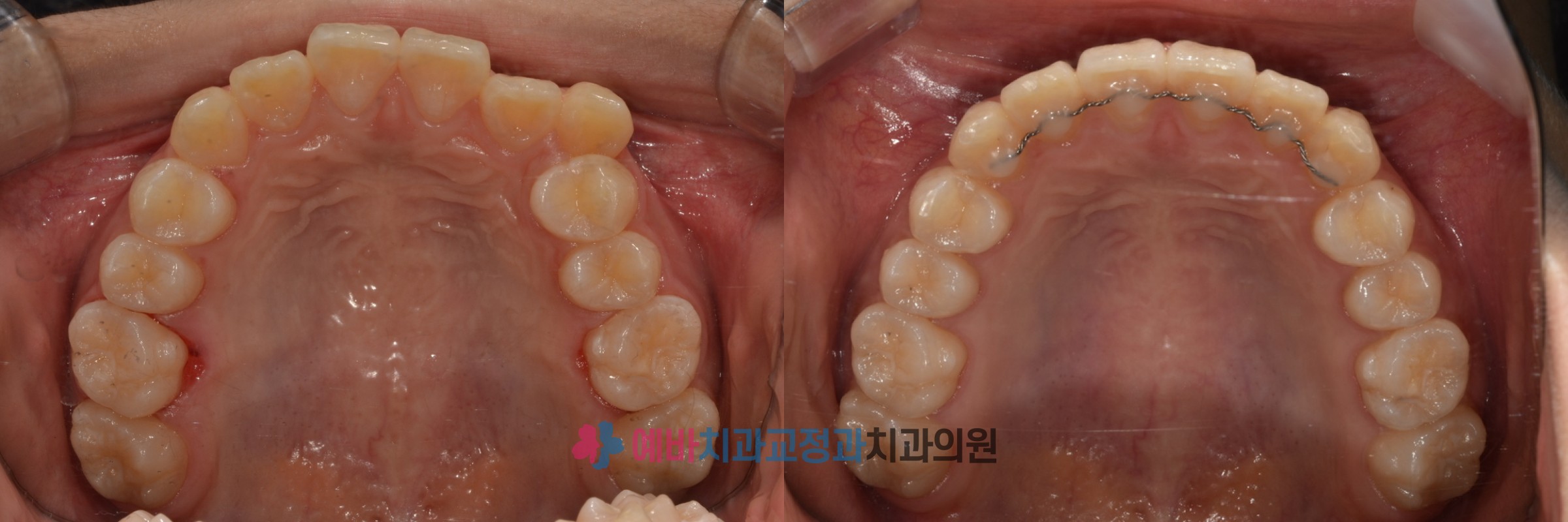 돌출입·덧니, 발치 없이 교정 전/후 전후사진