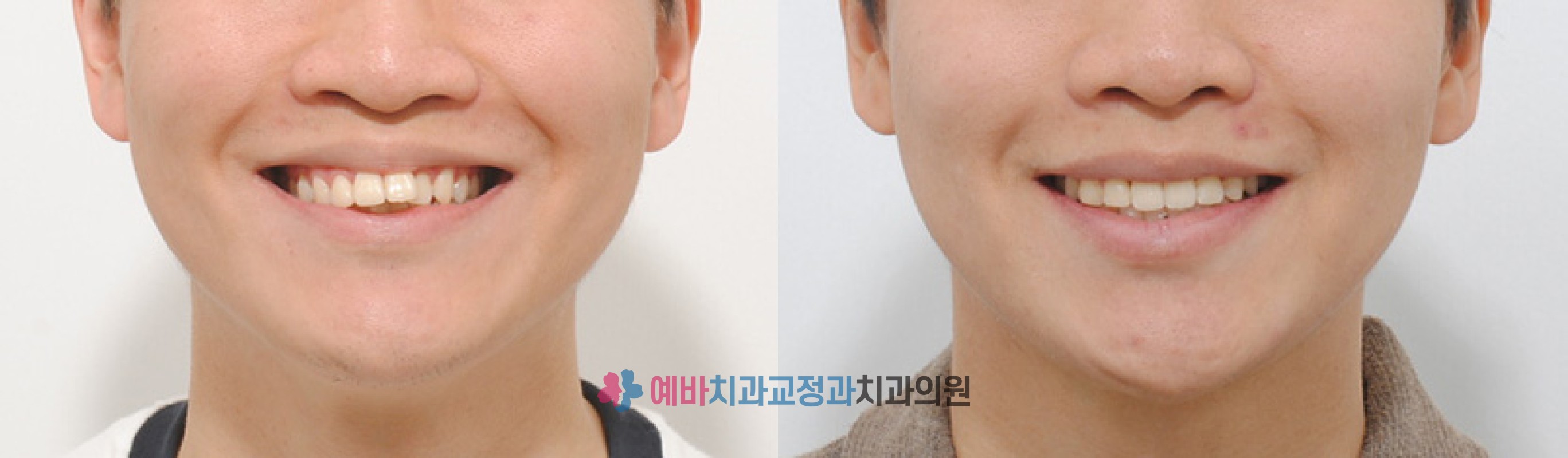 돌출입 비발치 교정 전/후
