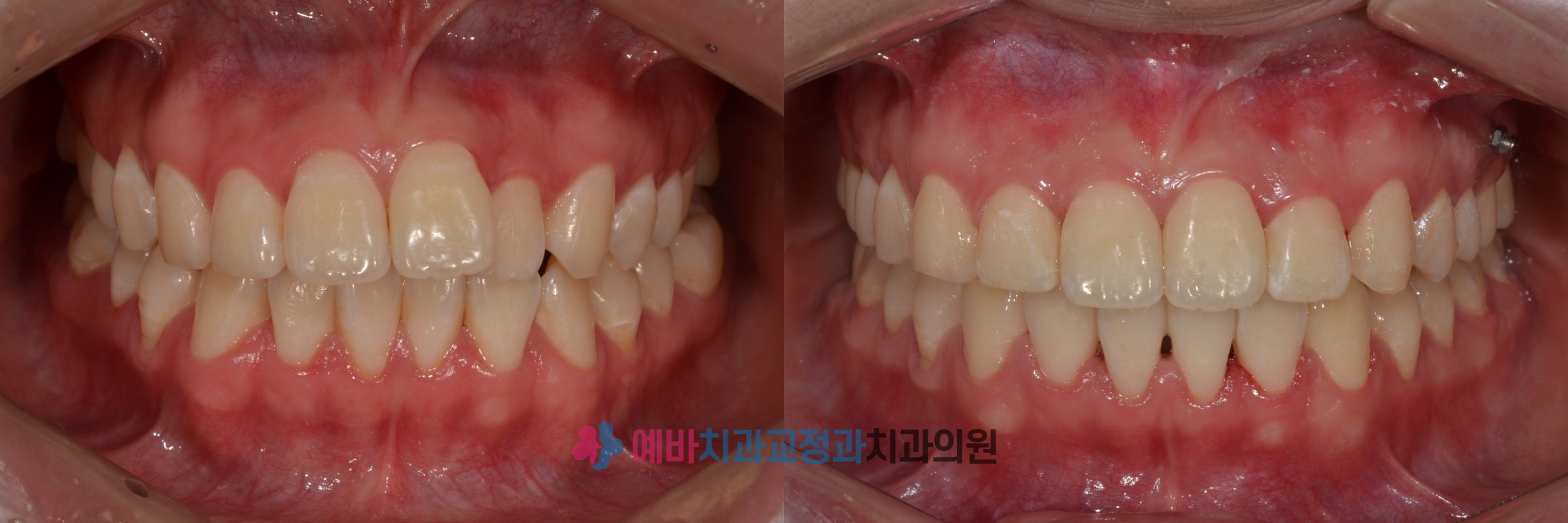 돌출입 비발치 교정 전/후  전후사진