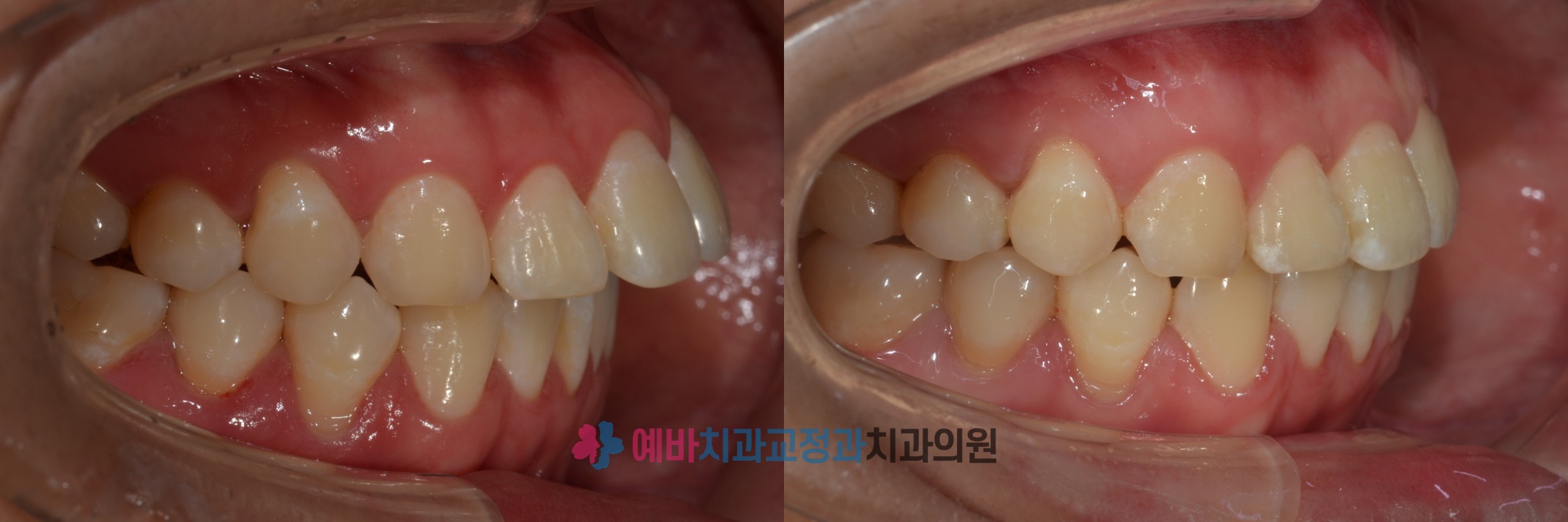 돌출입 비발치 교정 전/후  전후사진
