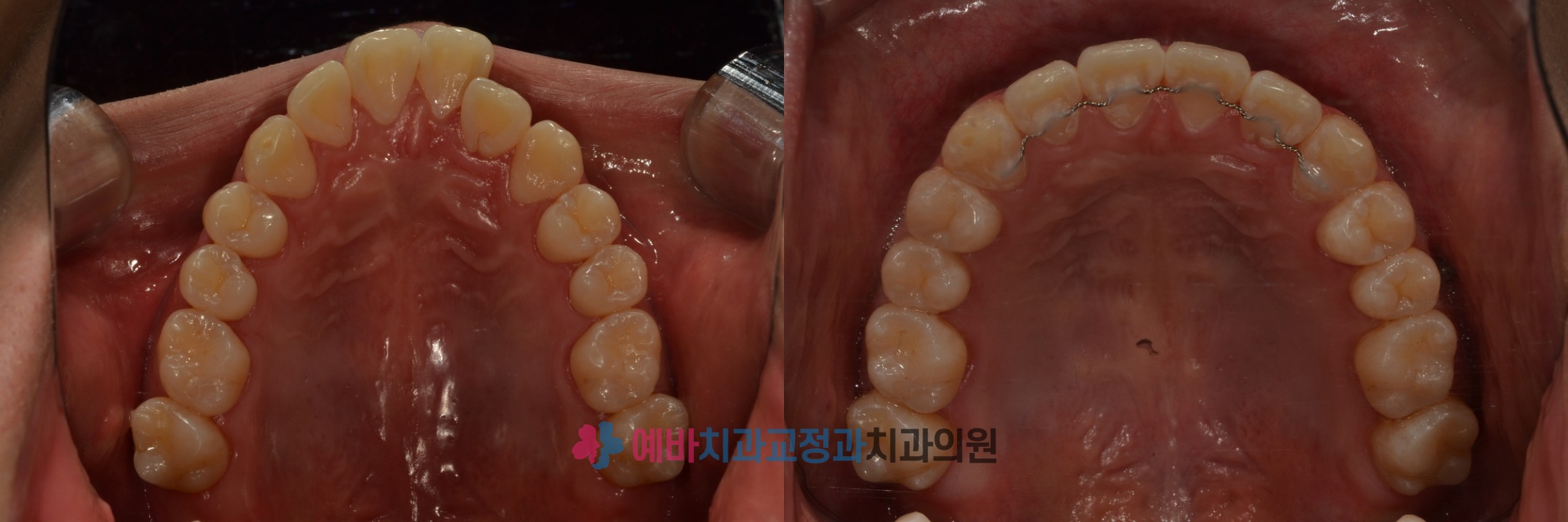 돌출입 비발치 교정 전/후  전후사진