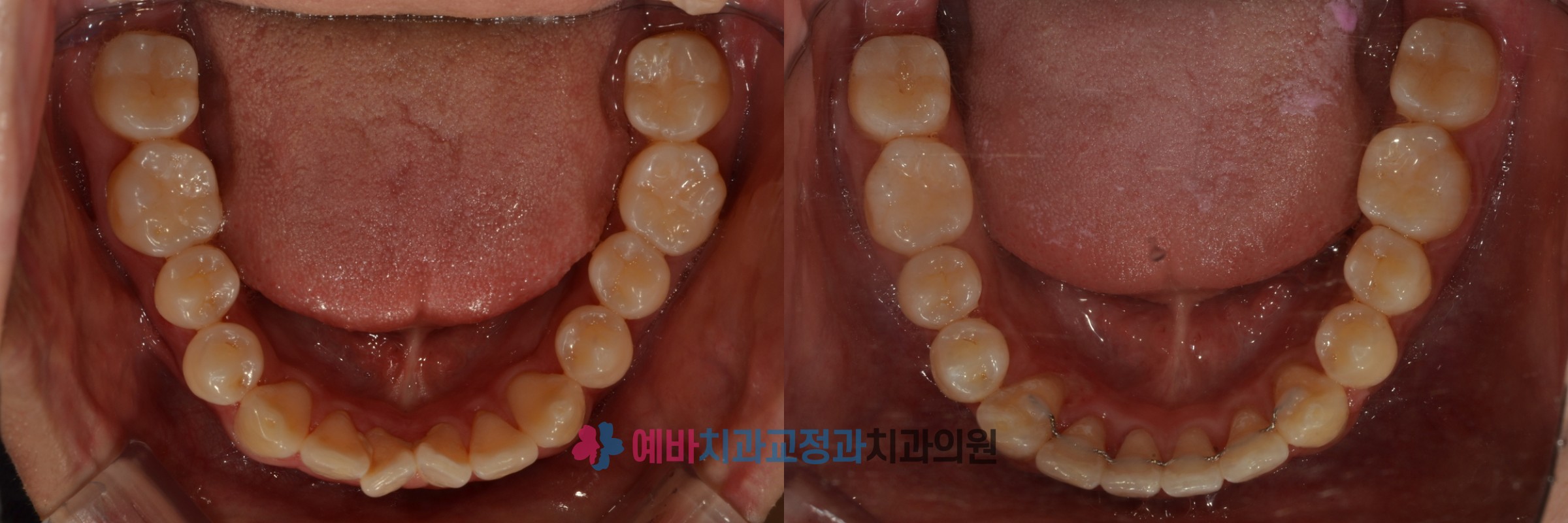 돌출입 비발치 교정 전/후  전후사진