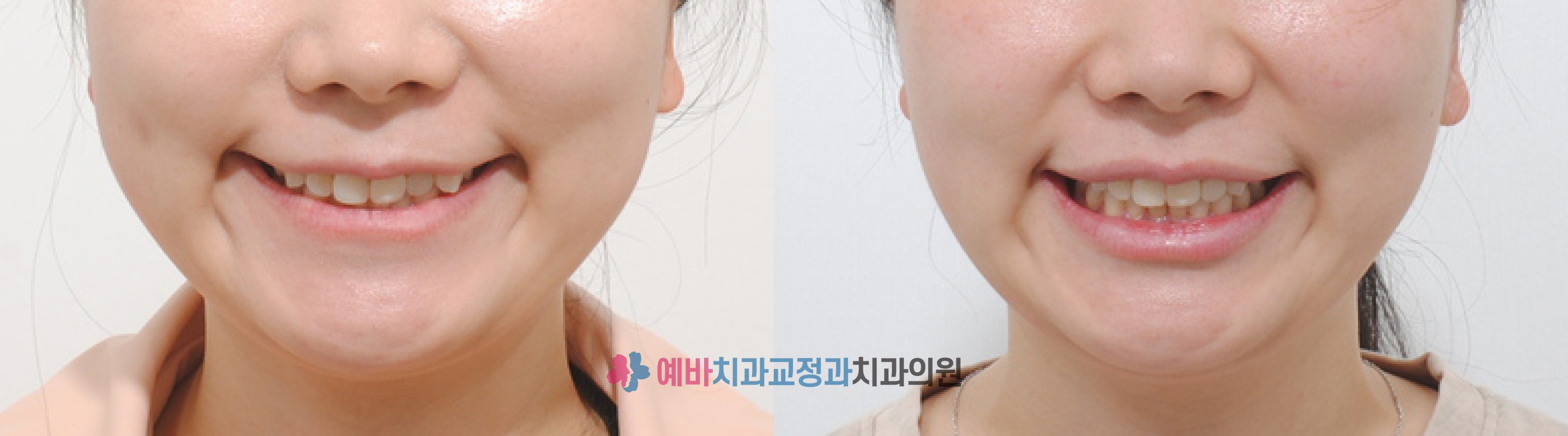 과개교합 비발치 인비절라인 교정 전/후 전후사진