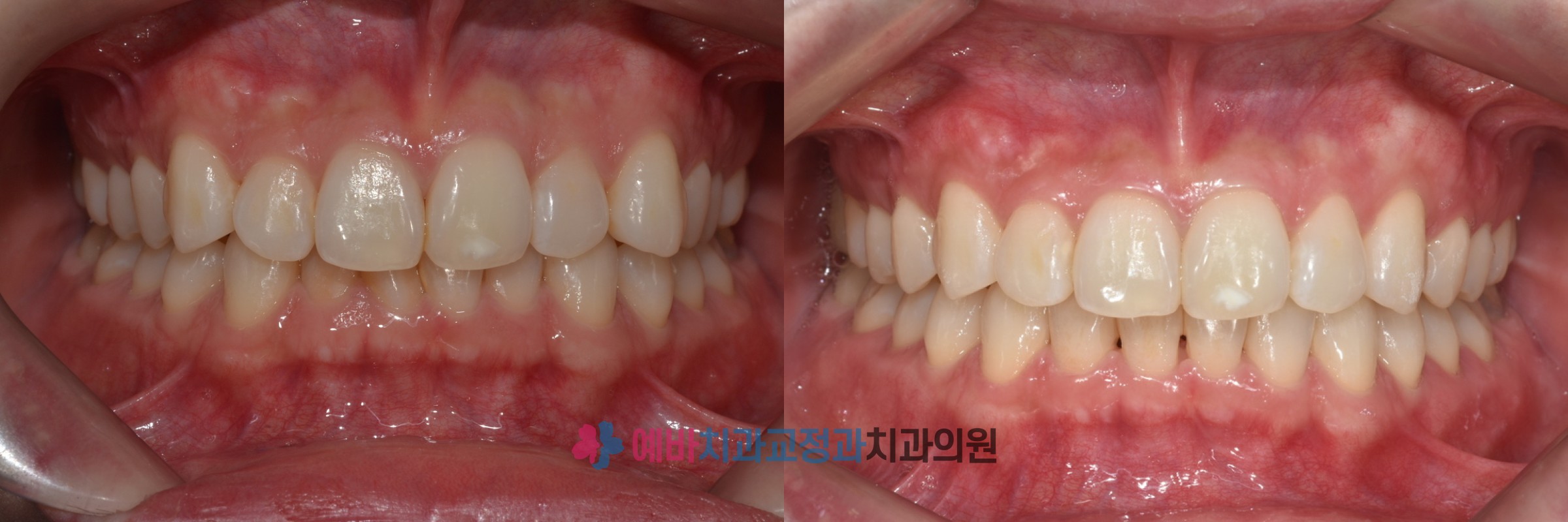 과개교합 비발치 인비절라인 교정 전/후 전후사진