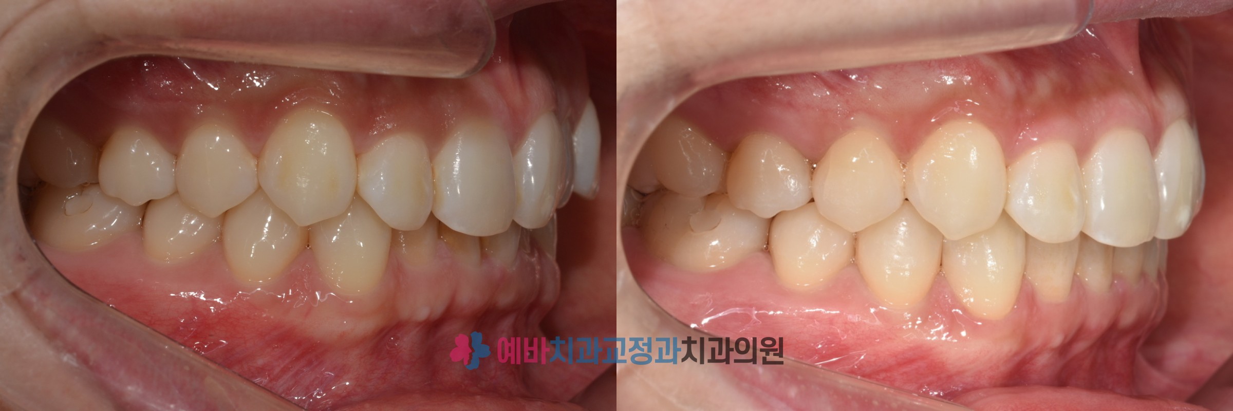 과개교합 비발치 인비절라인 교정 전/후 전후사진