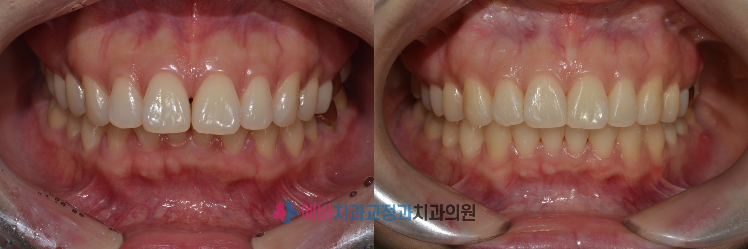 돌출입 교정 전/후