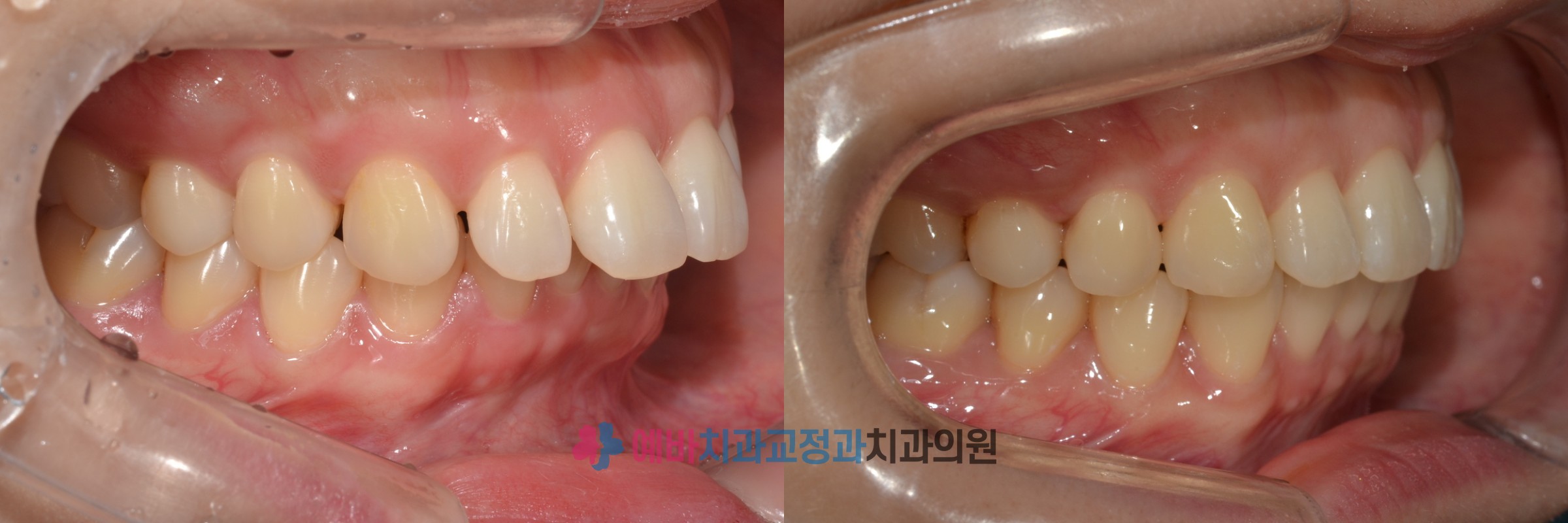 돌출입 교정 전/후 전후사진