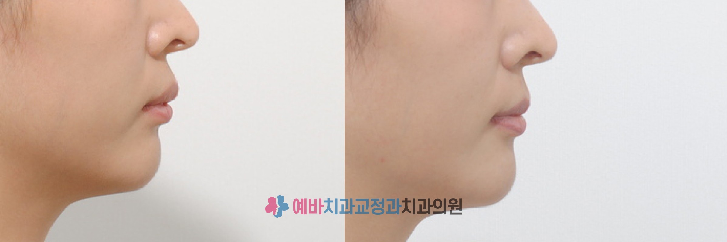 돌출입 교정 전/후 전후사진