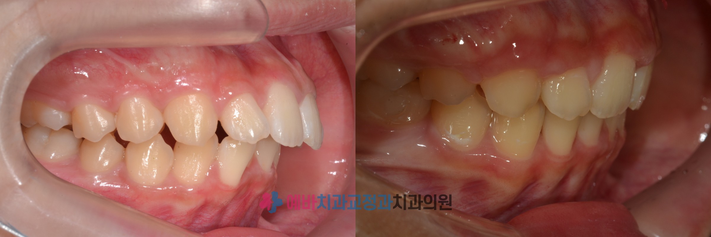 돌출입 교정 전/후 전후사진