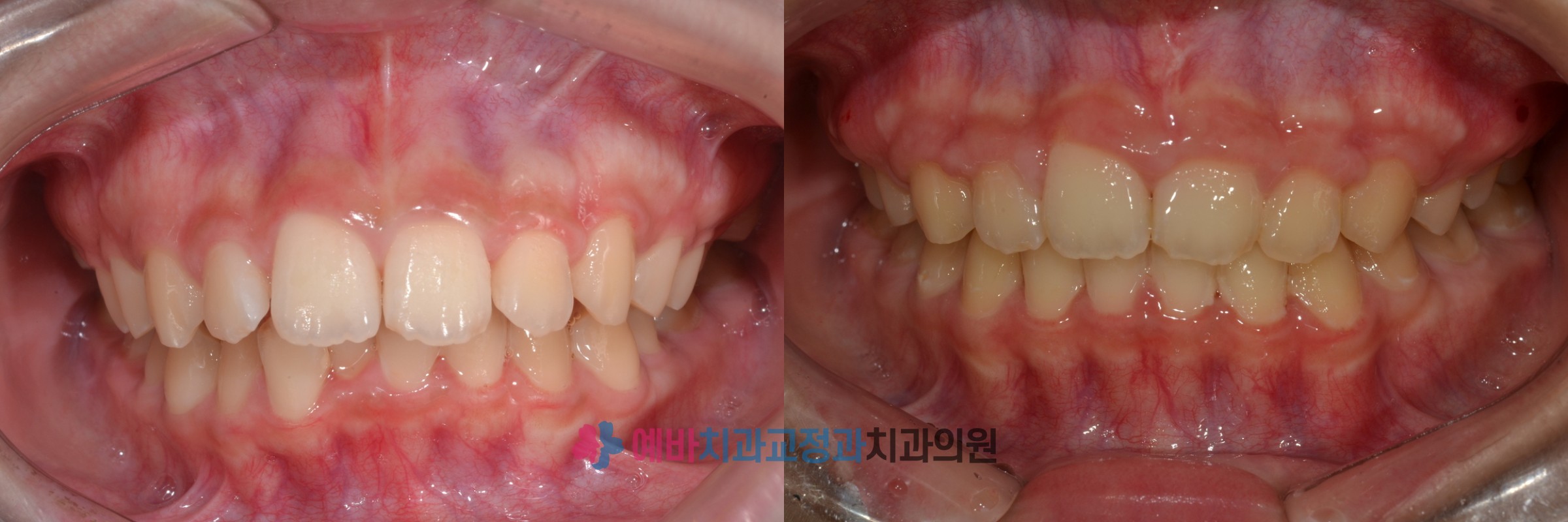 돌출입 교정 전/후 전후사진
