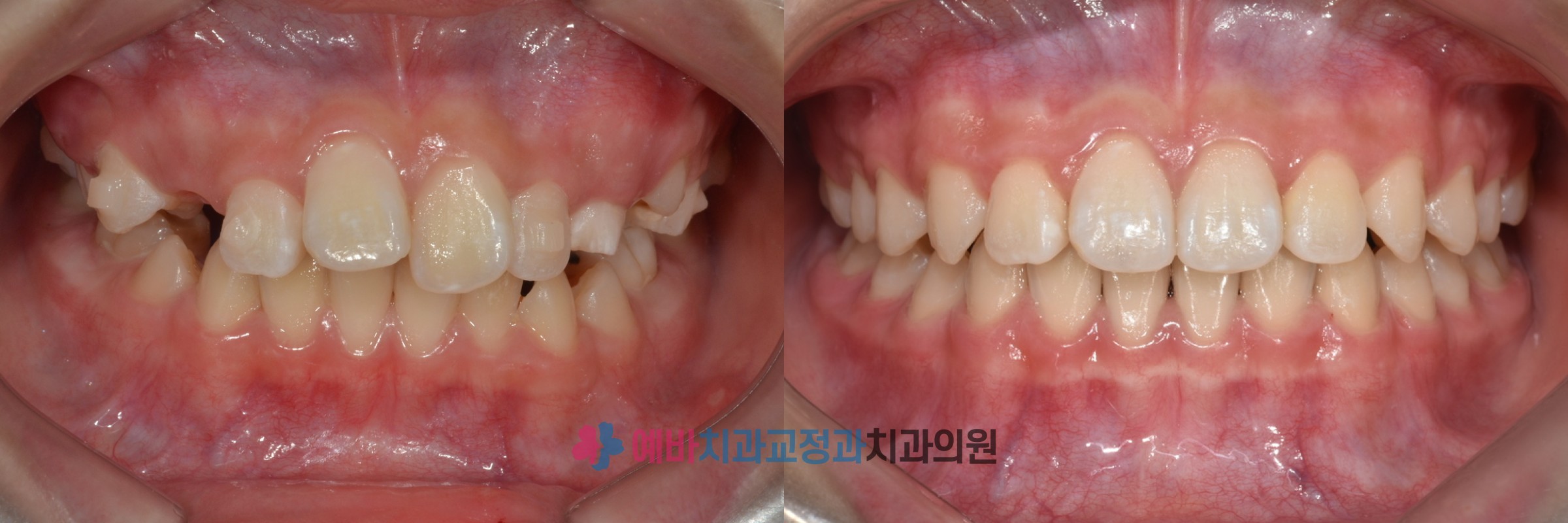성장교정 전/후