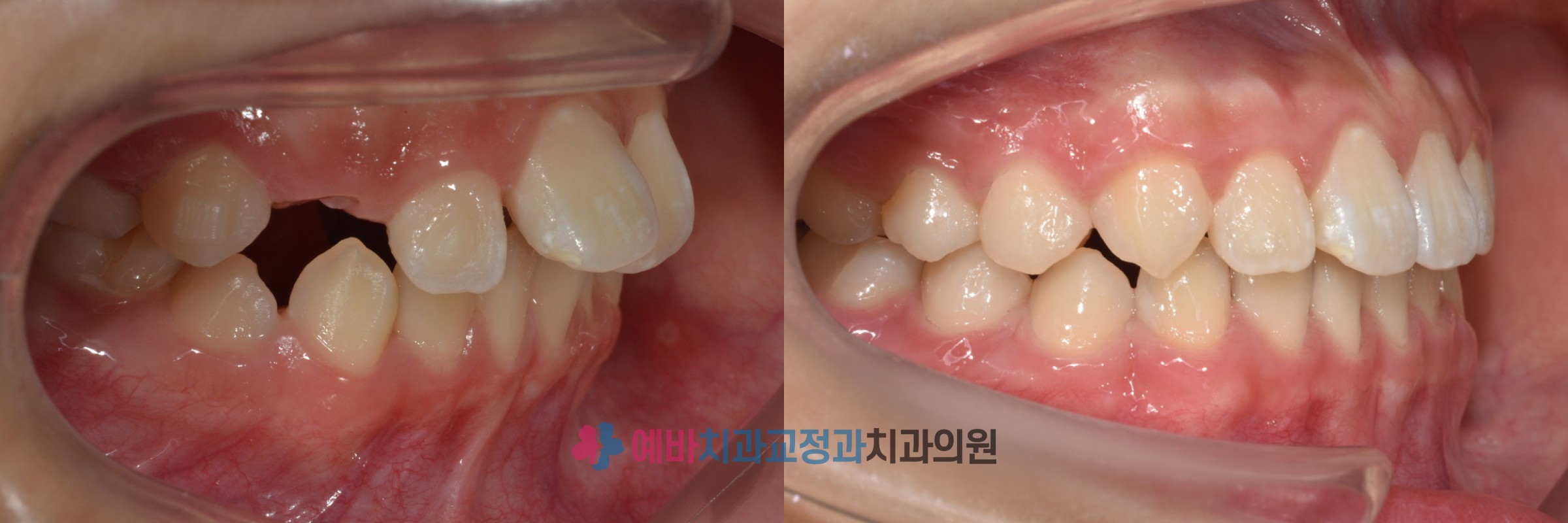 성장교정 전/후 전후사진