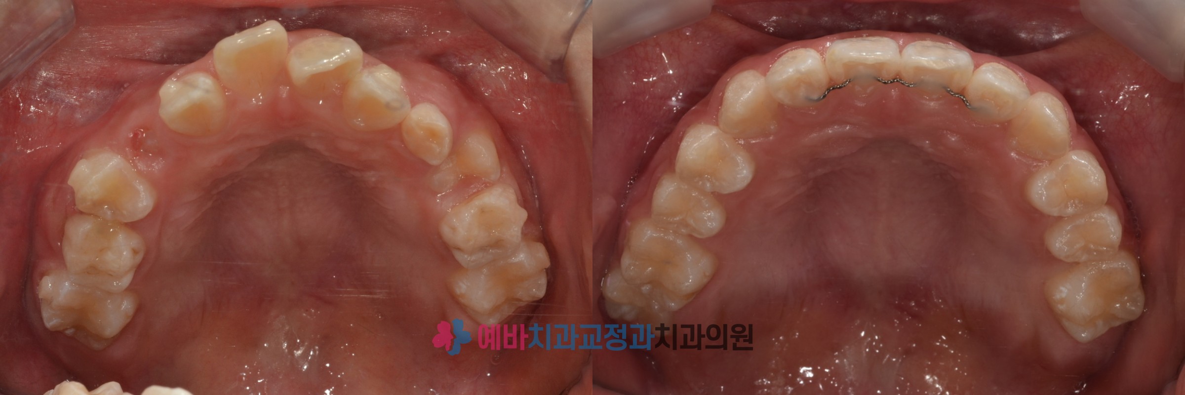 성장교정 전/후 전후사진