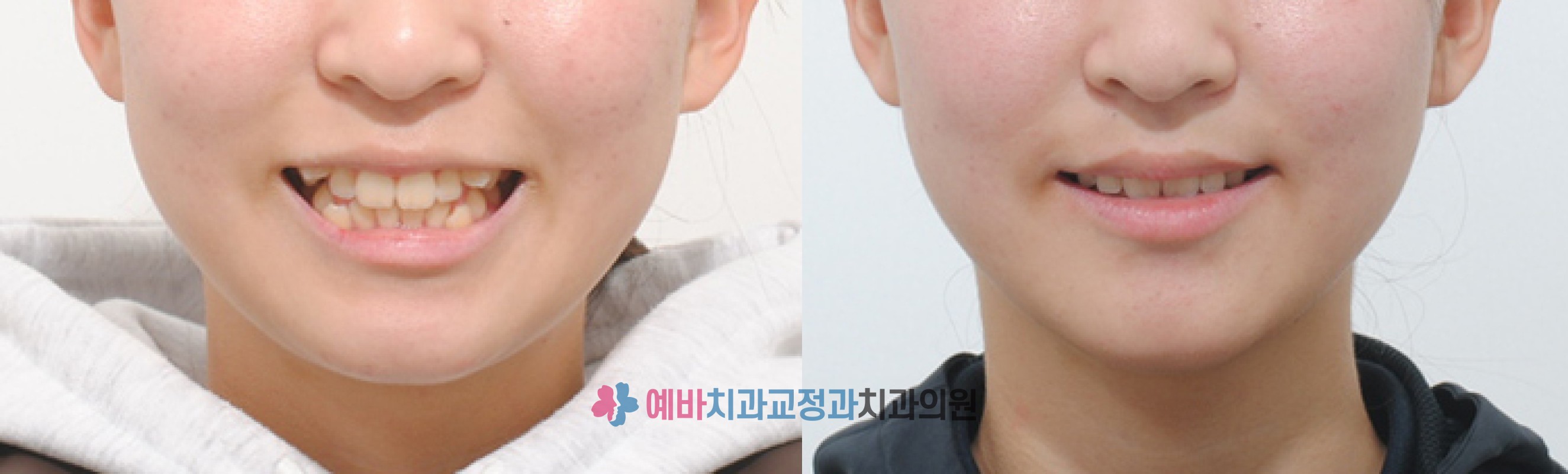 덧니 교정 전/후 전후사진